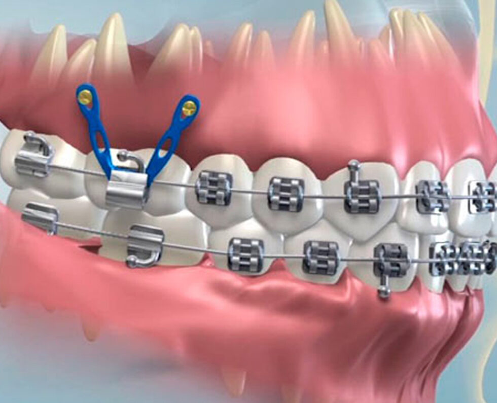 Braces Orthodontic Treatment | Western Dental Hospital -- Best Dental ...